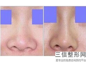 假体隆鼻多久可以完全消肿
