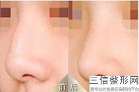 假体隆鼻项目介绍以及费用参考