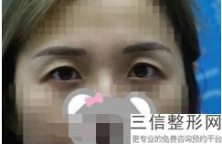 开眼角疤痕多久消失正常