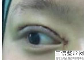 开眼角会变大吗
