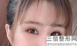 开眼角手术多少钱