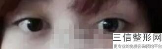 开眼角一般多久拆线