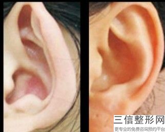 兰州招风耳多大可以矫正了