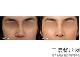 肋骨隆鼻多久可以修复