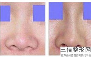 肋骨隆鼻能保持一辈子吗