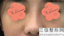 隆鼻完多久拆线