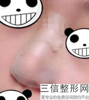 隆鼻修复率高吗多少钱