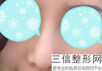 隆鼻修复良好的医生排名榜
