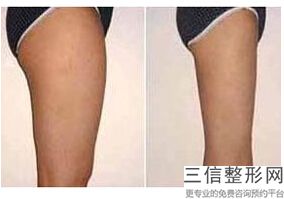 2023-2023丰胸注射玻尿酸多少钱一针(玻尿酸丰胸一次注射多少)