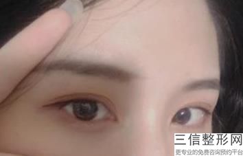 2023北京割双眼皮参考价格(北京割双眼皮的价格)