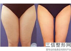 30支玻尿酸丰胸安全吗(30支玻尿酸丰胸安全吗知乎)