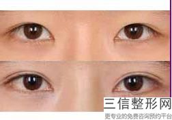 北京韩啸医疗美容门诊部割双眼皮技术怎么样(北京韩啸医疗美容门诊部割双眼皮技术怎么样)