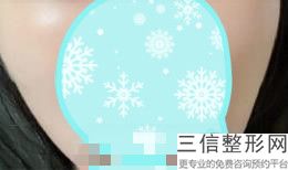 玻尿酸丰唇打几次可以定型(玻尿酸丰唇打几次可以定型了)