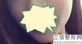 玻尿酸丰唇需要麻醉吗(玻尿酸丰唇需要麻醉吗多少钱)