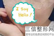 玻尿酸丰唇肿成香肠嘴正常吗(嘟嘟唇第二天肿得像鸭子嘴)
