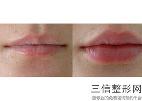 唇侧矫正和舌侧矫正哪个好(唇侧矫正和舌侧矫正哪个好一点)