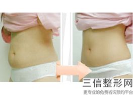 打丰胸针能保持多久(不用检查正规丰胸品牌)