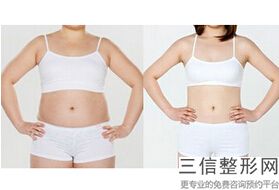 大腿抽脂大概要多少钱(腿部抽脂肪要花多少钱)