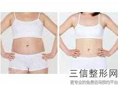 大腿抽脂多久完全消肿(大腿抽脂多久完全消肿正常)
