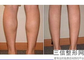 大腿抽脂有什么坏处(大腿抽脂有什么坏处和好处)