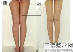 大腿抽脂比较严重的并发症有哪些(大腿抽脂比较严重的并发症有哪些呢)