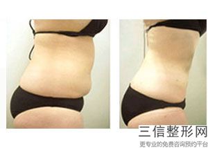大腿环吸多久可以消肿啊(大腿环吸多久可以消肿啊图片)