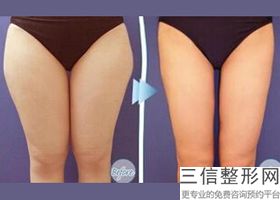 大腿吸脂多久可以消肿看到效果(大腿吸脂多久可以消肿看到效果呢)