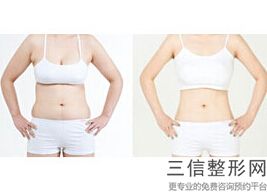 大腿吸脂多久腿才不痛(大腿吸脂多久腿才不痛了呢)
