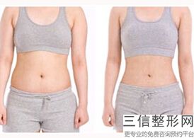 大腿吸脂多久走路不痛不肿(大腿吸脂多久走路不痛不肿了)