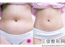 大腿吸脂坏处是什么(大腿吸脂坏处是什么呢)