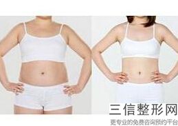 大腿吸脂有副作用吗(大腿吸脂有副作用吗女性)