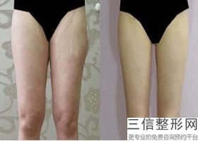 大腿吸脂有什么危害吗(抽脂肪20斤一般多少钱)