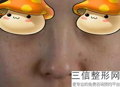 垫鼻基底需要多少钱(垫鼻基底前后对比照)