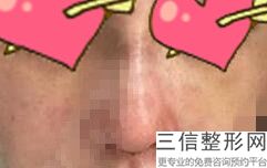 垫鼻基底有什么后遗症(垫鼻基底是长久的吗)