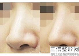 垫下巴和垫鼻子那个手术大(垫下巴和垫鼻子哪个手术大)