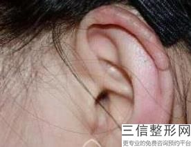 耳轮廓美化可以改善什么问题(耳部轮廓)