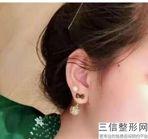 耳软骨隆鼻多少钱曙光.在那里(耳软骨隆鼻的价钱)