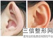 丰耳垂有什么危害(耳垂填充手术案例图片)
