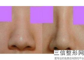 刚做完鼻综合注意事项(刚做完鼻综合注意什么)