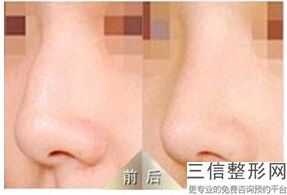 割软骨垫鼻子软骨会再长出来吗(割软骨垫鼻子软骨会再长出来吗图片)