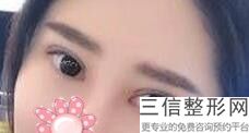 割双眼皮好评北京艺星(割双眼皮的好评怎么写)