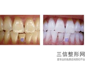 箍牙齿的流程(箍牙齿的流程视频)