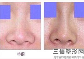 硅胶隆鼻价格大概多少(硅胶隆鼻价格大概多少钱)