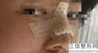 韩式隆鼻整形手术(韩式隆鼻整形手术要多少钱)