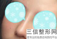 韩式生科假体隆鼻可以放一辈子吗(韩式生科假体隆鼻恢复要多久)