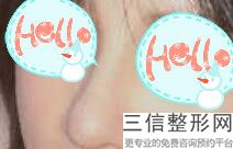 假体隆鼻可以保持多少年(假体隆鼻能保持多少年)
