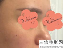 假体隆鼻可以维持几年(假体隆鼻可以维持几年时间)