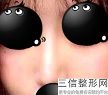 假体隆鼻取出多久可以再做(假体隆鼻取出多久可以再做第二次)
