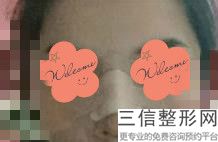 假体隆鼻什么材质好(假体隆鼻什么材质好一点)