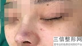 昆山割双眼皮多少钱(昆山割双眼皮多少钱一次)